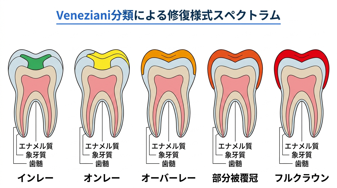 修復様式の連続スペクトラム（インレー・オンレー・クラウンの違いを示す図）