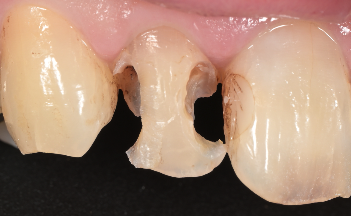 前歯DB：う蝕除去後の歯質の状態