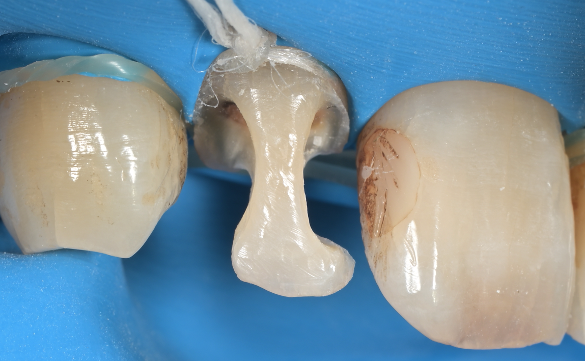 前歯DB：ラバーダム防湿後・接着処理中