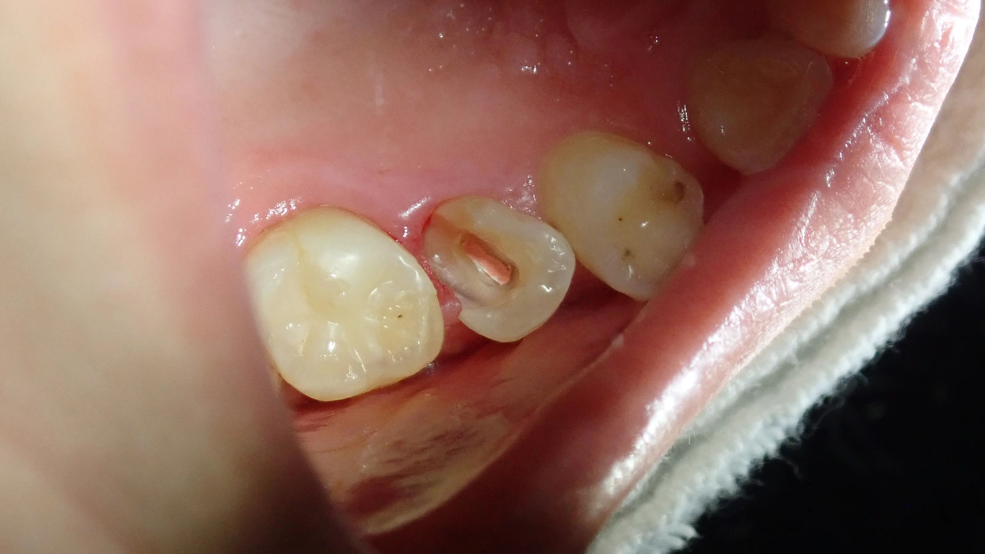 上顎小臼歯ダイレクトボンディング｜坂寄歯科医院（取手市藤代） - 画像2