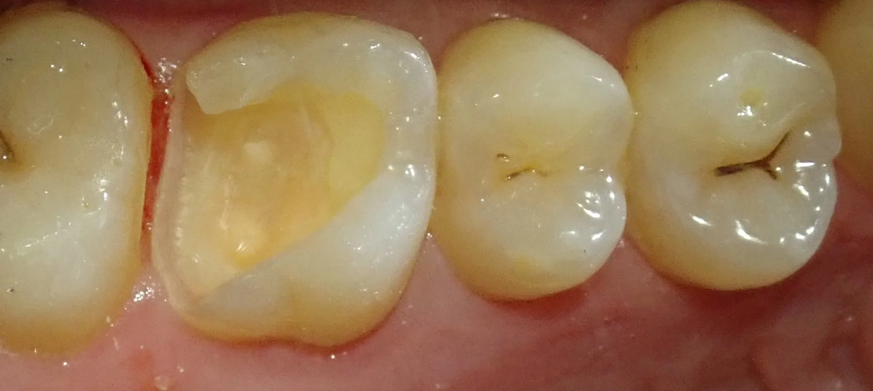 テフロンテープを用いたレジン治療｜坂寄歯科医院（取手市藤代） - 画像3