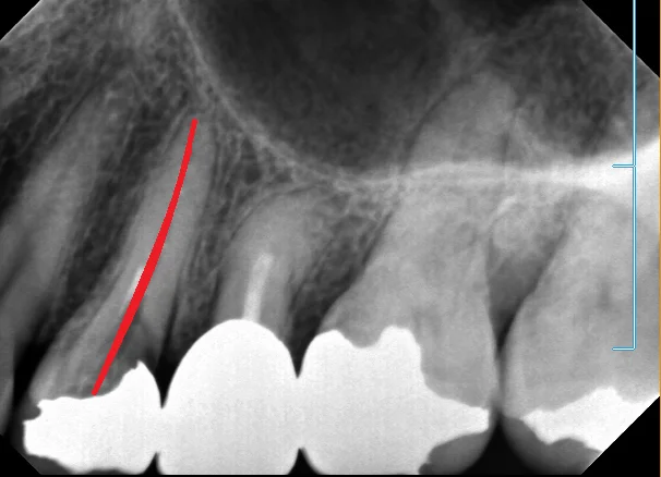 神経の治療⑤｜坂寄歯科医院（取手市藤代） - 画像3