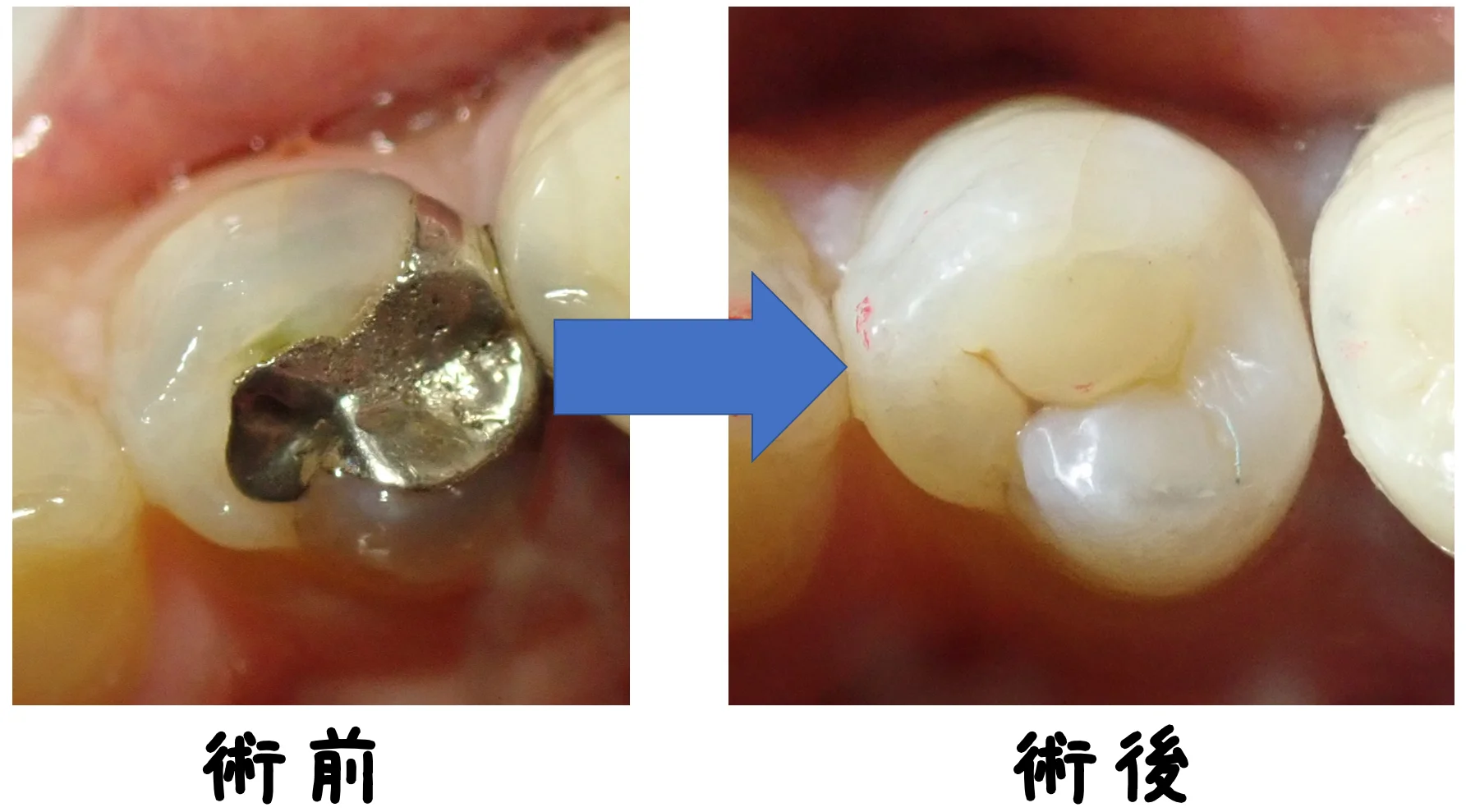 ダイレクトボンディング｜坂寄歯科医院（取手市藤代） - 画像5