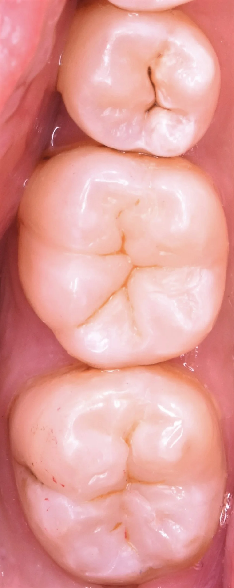 奥歯2本の治療を1日で。|坂寄歯科医院(取手市藤代) - 画像4