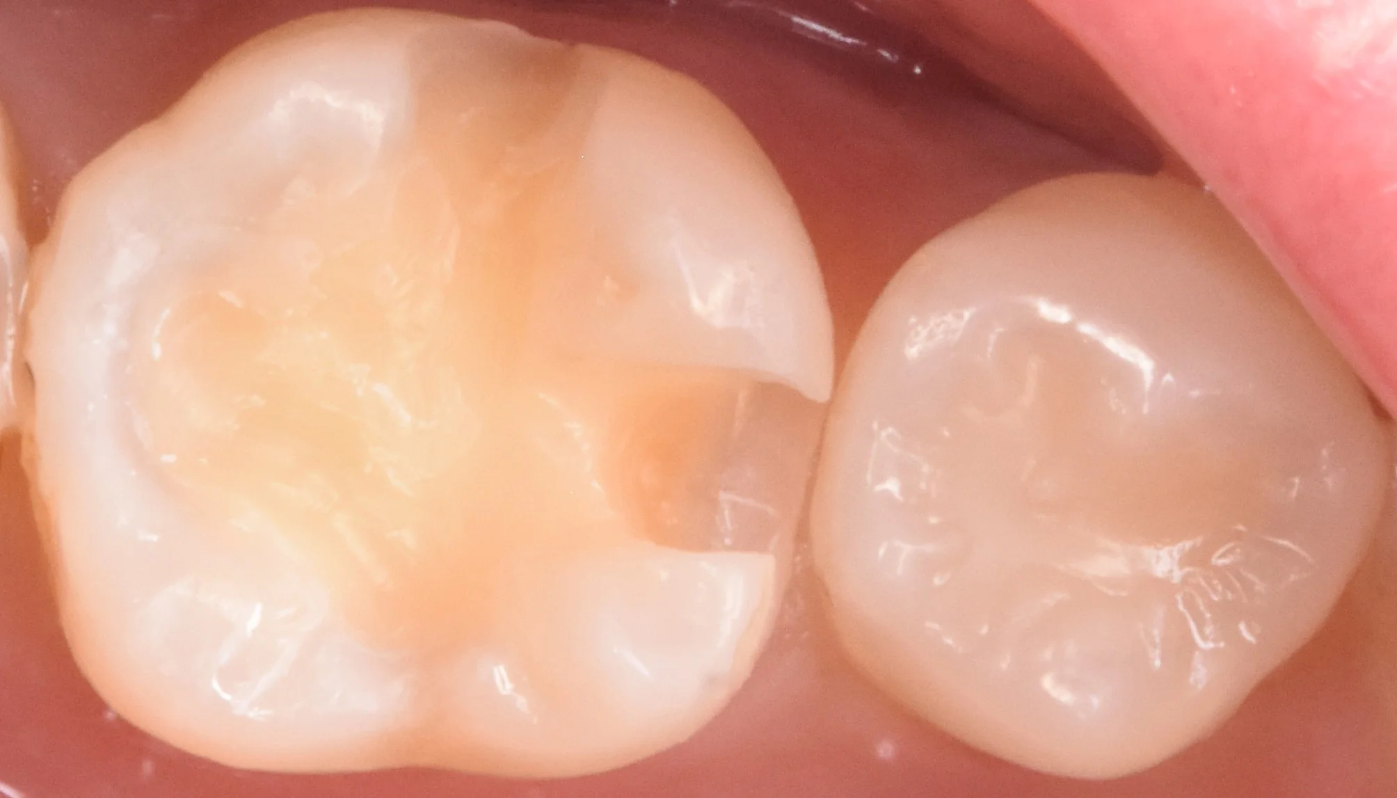 奥歯を白い詰め物で治療。｜坂寄歯科医院（取手市藤代） - 画像2