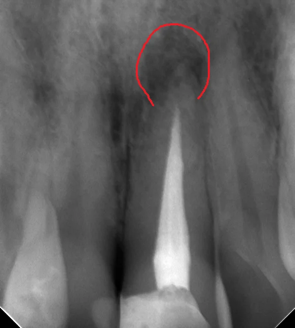 前歯の根管治療｜坂寄歯科医院（取手市藤代） - 画像2