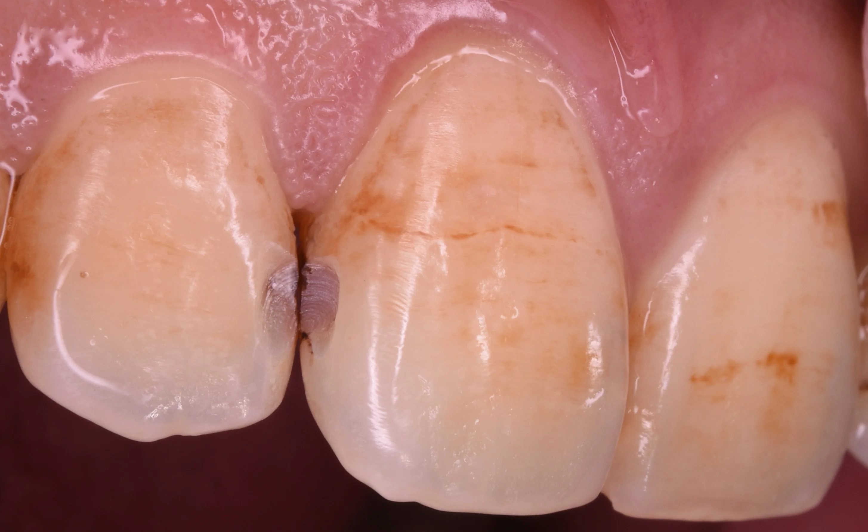 前歯の虫歯の治療で可能な限り歯を温存したケース。|坂寄歯科医院(取手市藤代) - 画像2