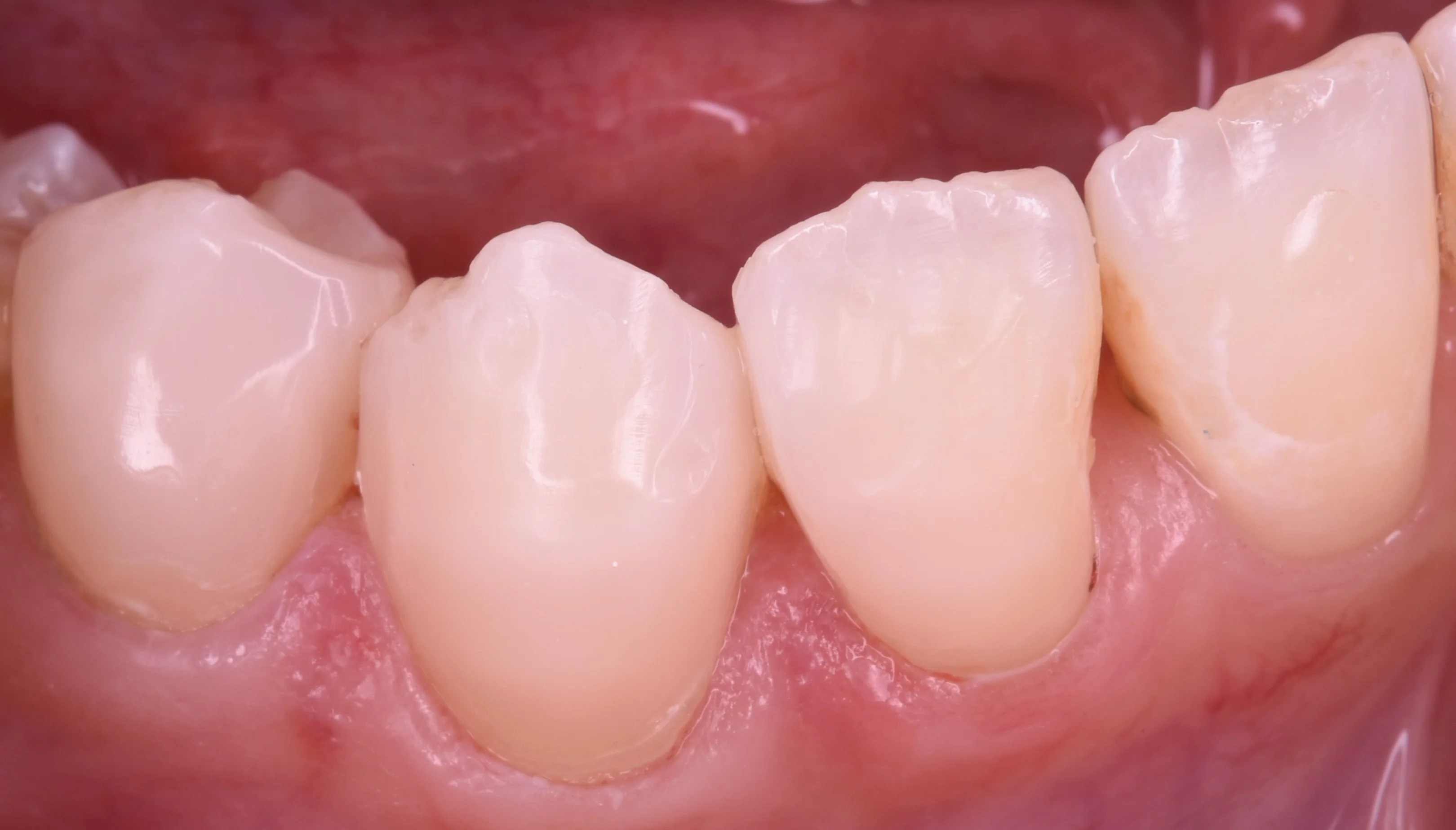 前歯を纏めて白く。｜坂寄歯科医院（取手市藤代） - 画像3