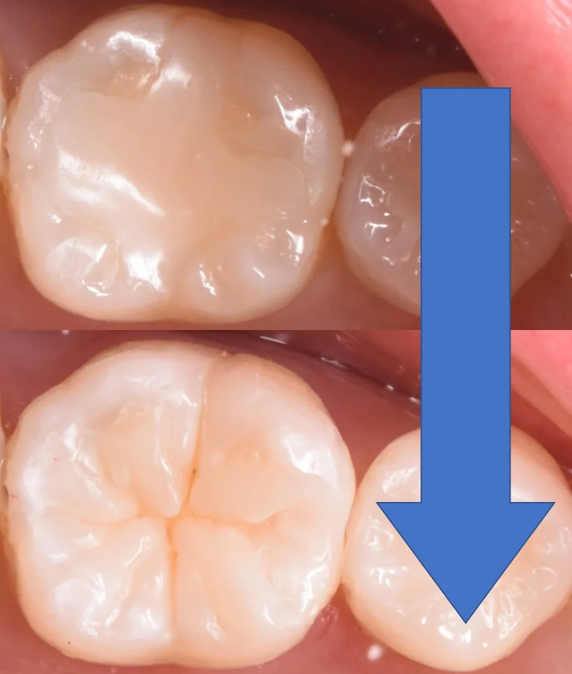 奥歯を白い詰め物で治療。｜坂寄歯科医院（取手市藤代） - 画像4