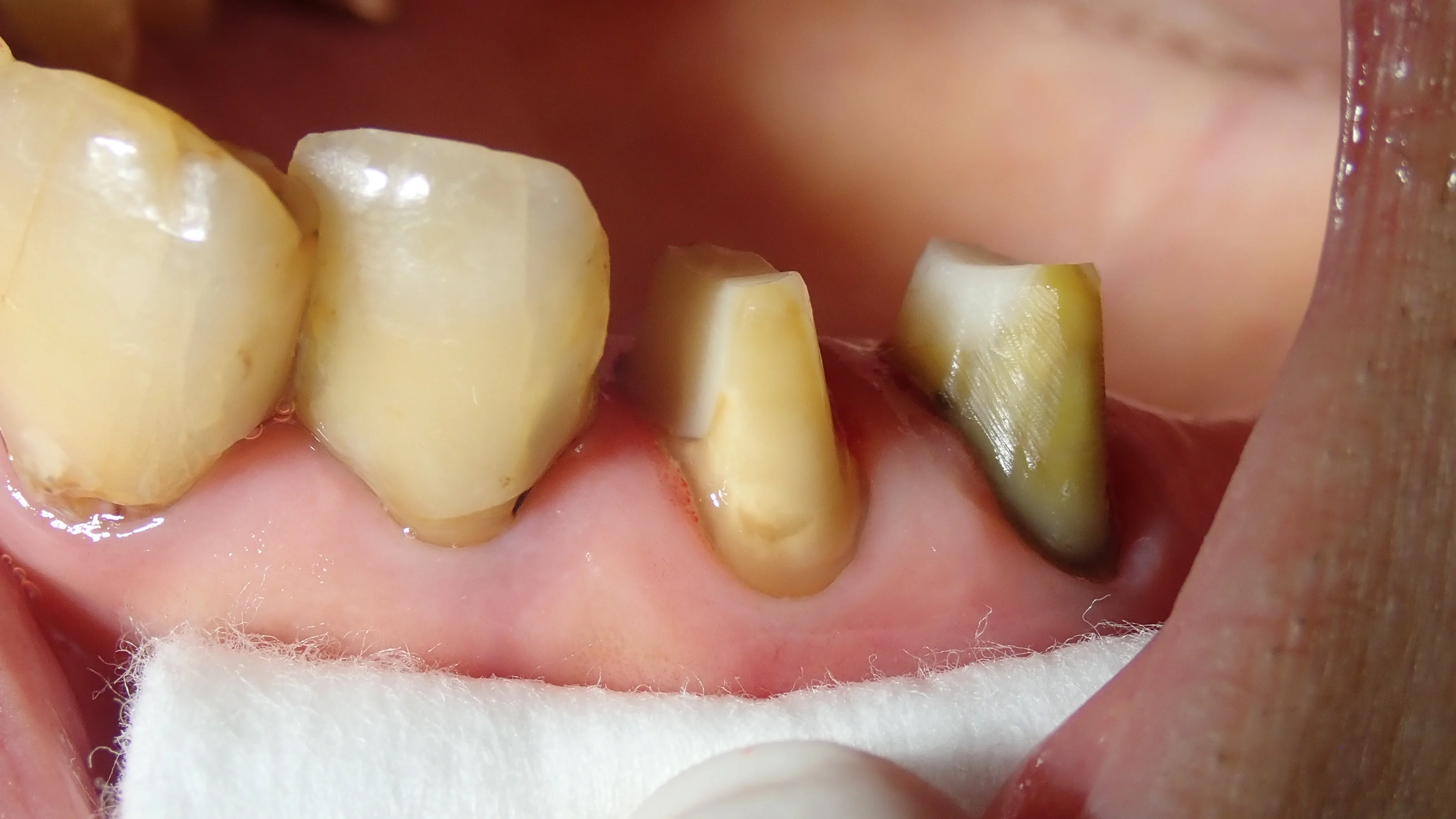 硬質レジンジャケット冠｜坂寄歯科医院（取手市藤代） - 画像2