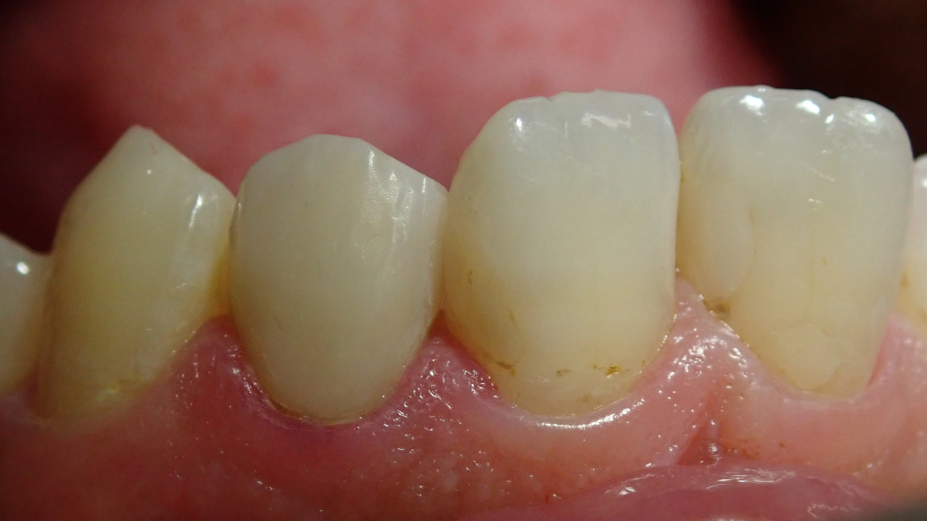 前歯のダイレクトベニア｜坂寄歯科医院（取手市藤代） - 画像4