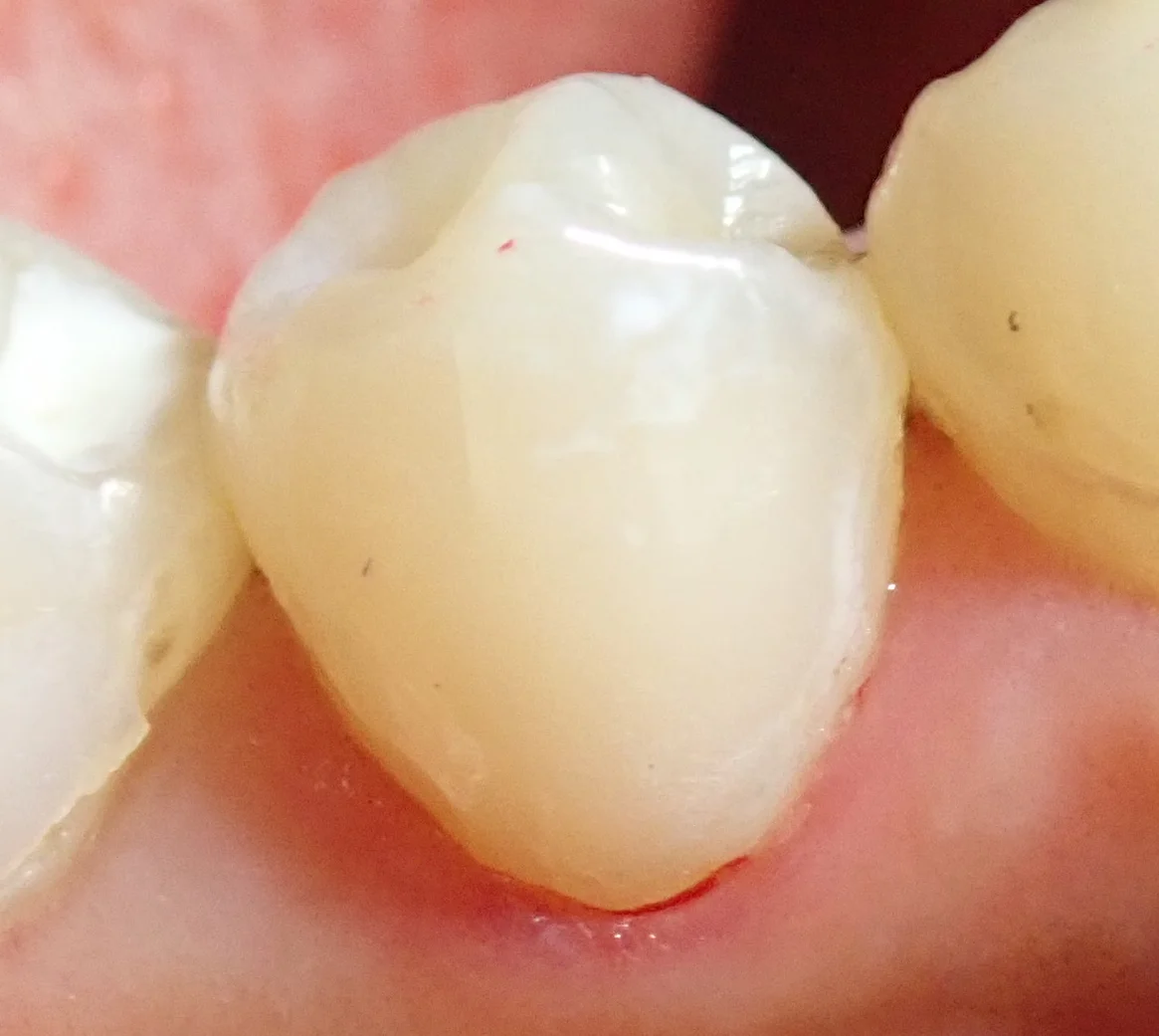 圧排糸を使ったレジン治療。｜坂寄歯科医院（取手市藤代） - 画像6