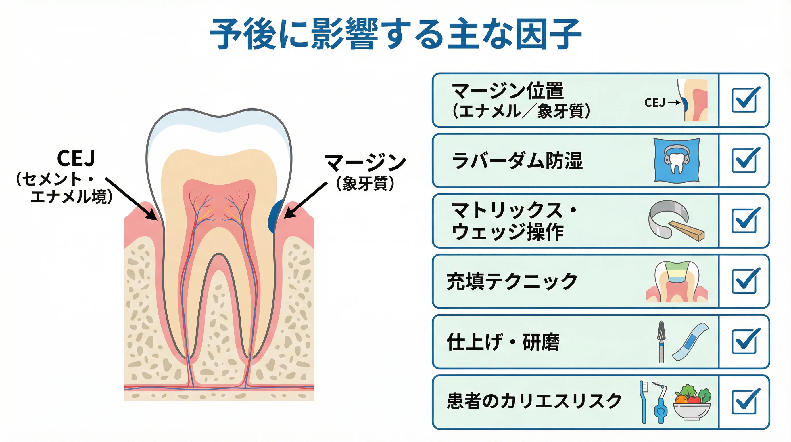 歯肉縁下CR修復の予後に影響する主な因子（マージン位置〔エナメル質／象牙質〕、ラバーダム防湿、マトリックス・ウェッジ操作、充填テクニック、仕上げ研磨、患者さんのカリエスリスク）をまとめた説明図
