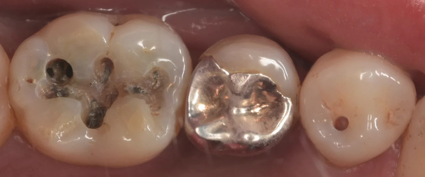 古い金属にできた虫歯をその日のうちに白い詰め物で。｜坂寄歯科医院（取手市藤代） - 画像2