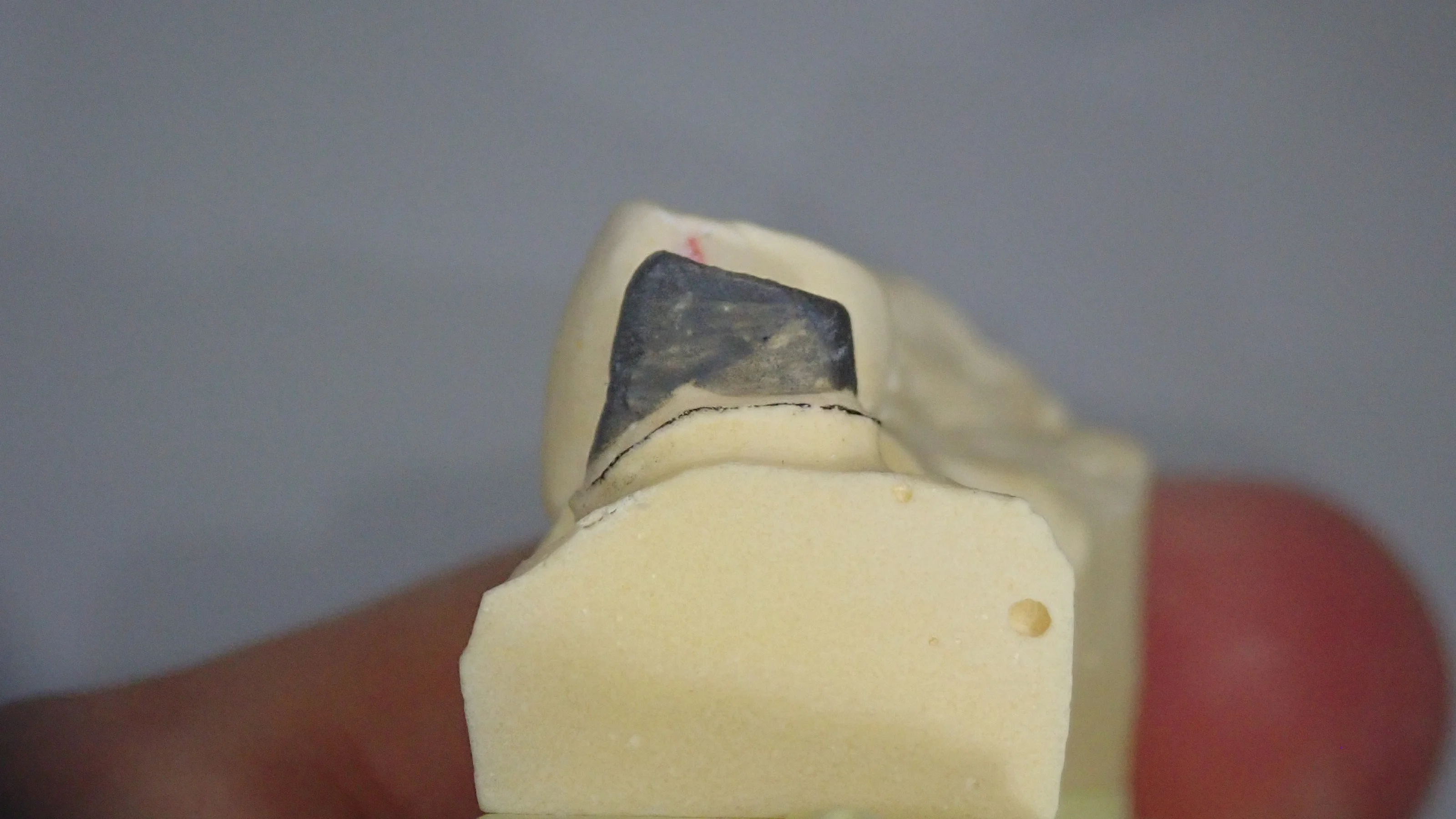 メタルクラウン｜坂寄歯科医院（取手市藤代） - 画像2