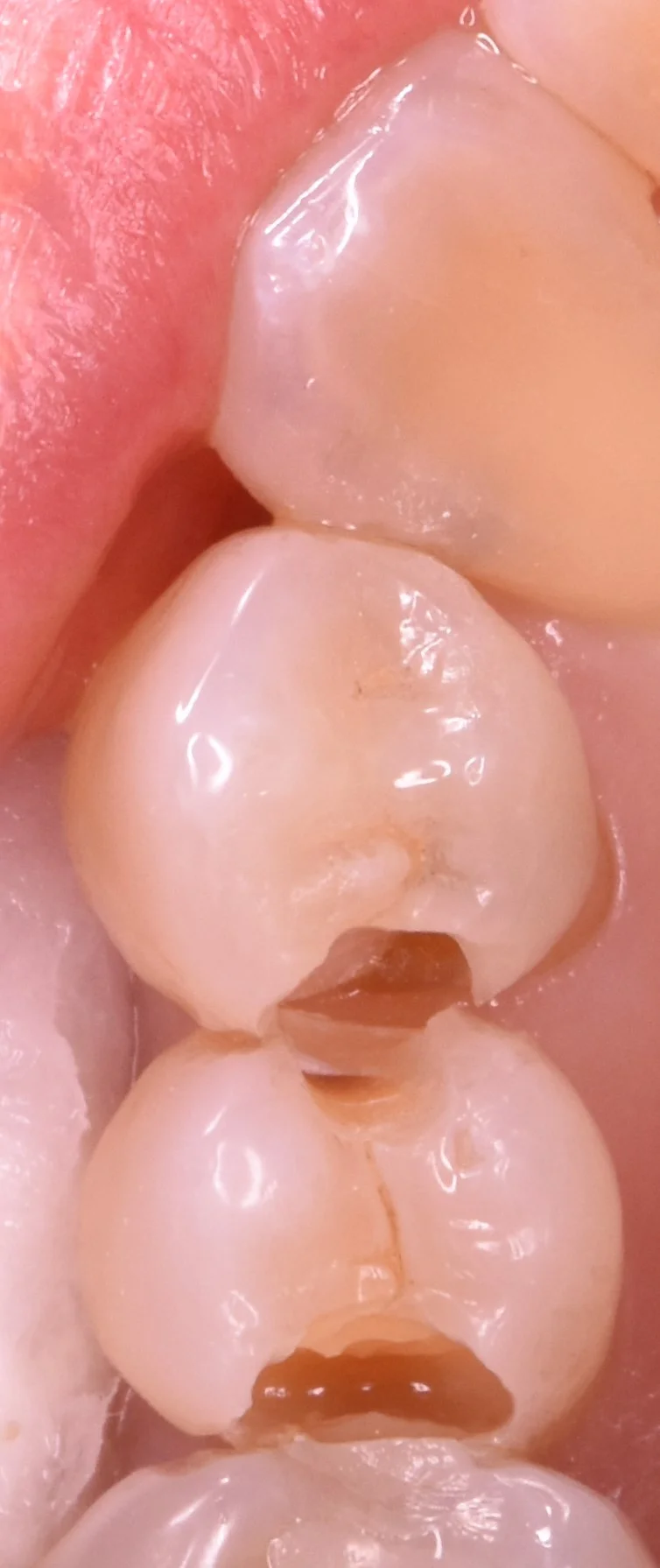 奥歯の歯並びが悪くなってしまっている所の治療｜坂寄歯科医院（取手市藤代） - 画像2