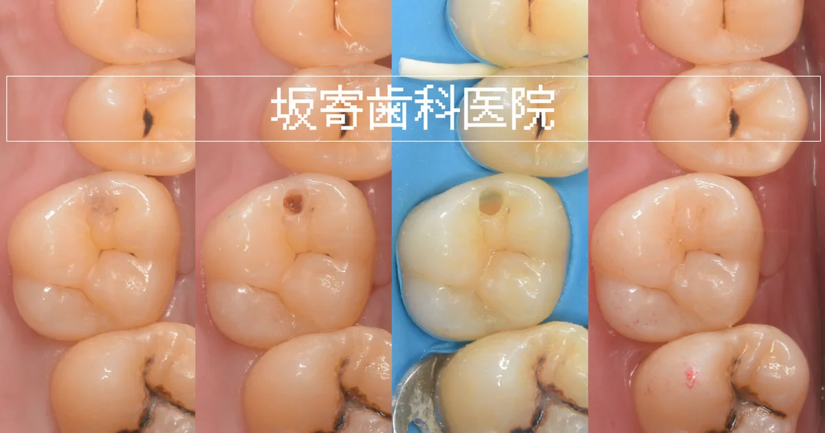 ダイレクトボンディング症例：右上6 むし歯治療 20代男性 術前・術後