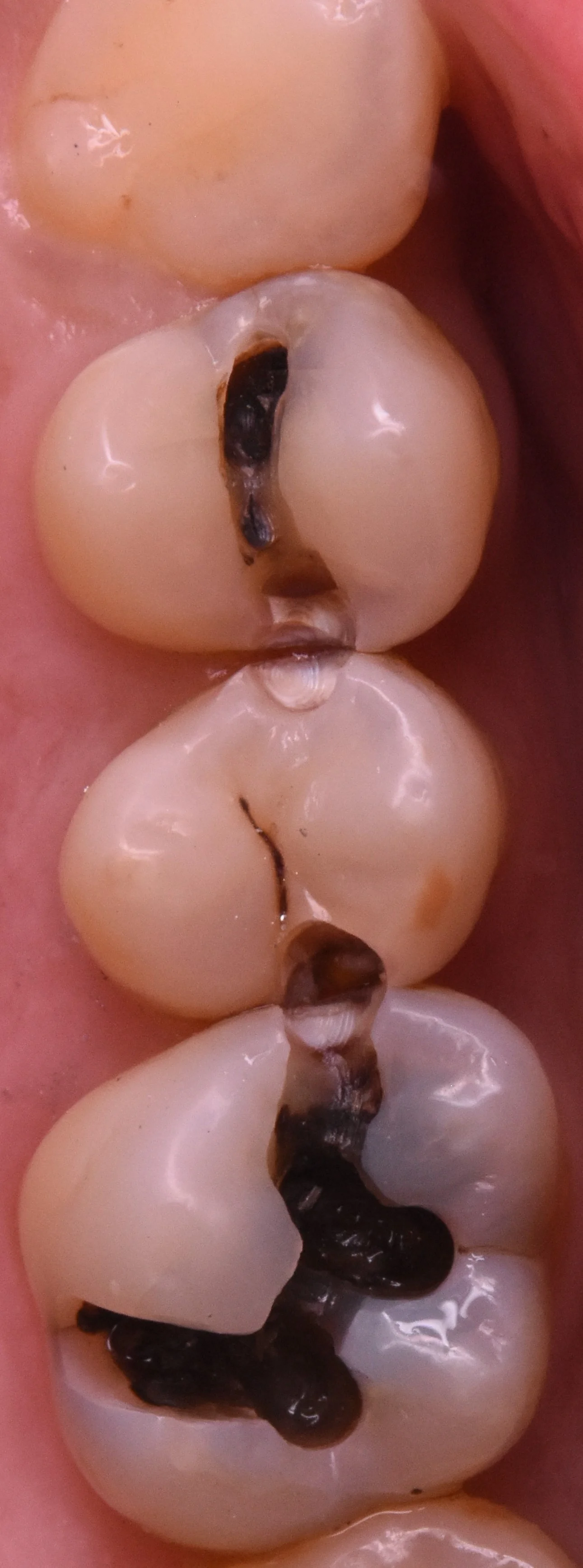 奥歯3本を纏めて一気に治療。｜坂寄歯科医院（取手市藤代） - 画像2