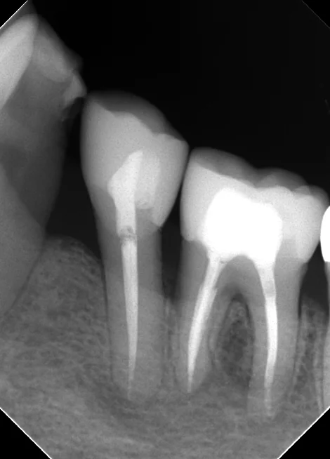 レジンでは無理ですって！再び･･･｡｜坂寄歯科医院（取手市藤代） - 画像3