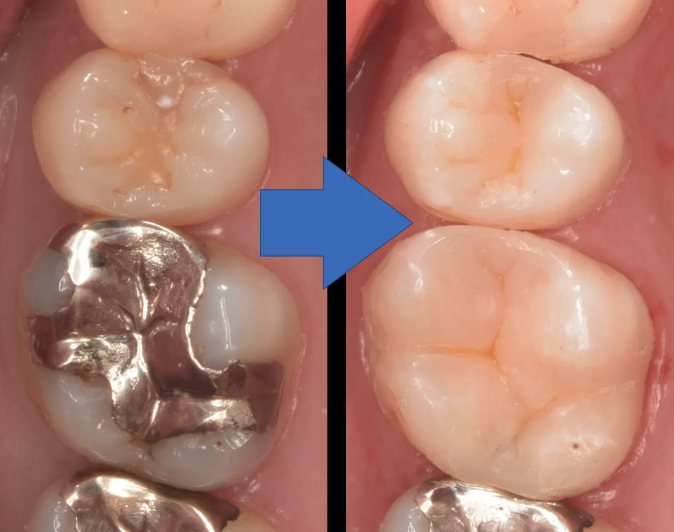 歯科医師の方を治療。｜坂寄歯科医院（取手市藤代） - 画像5