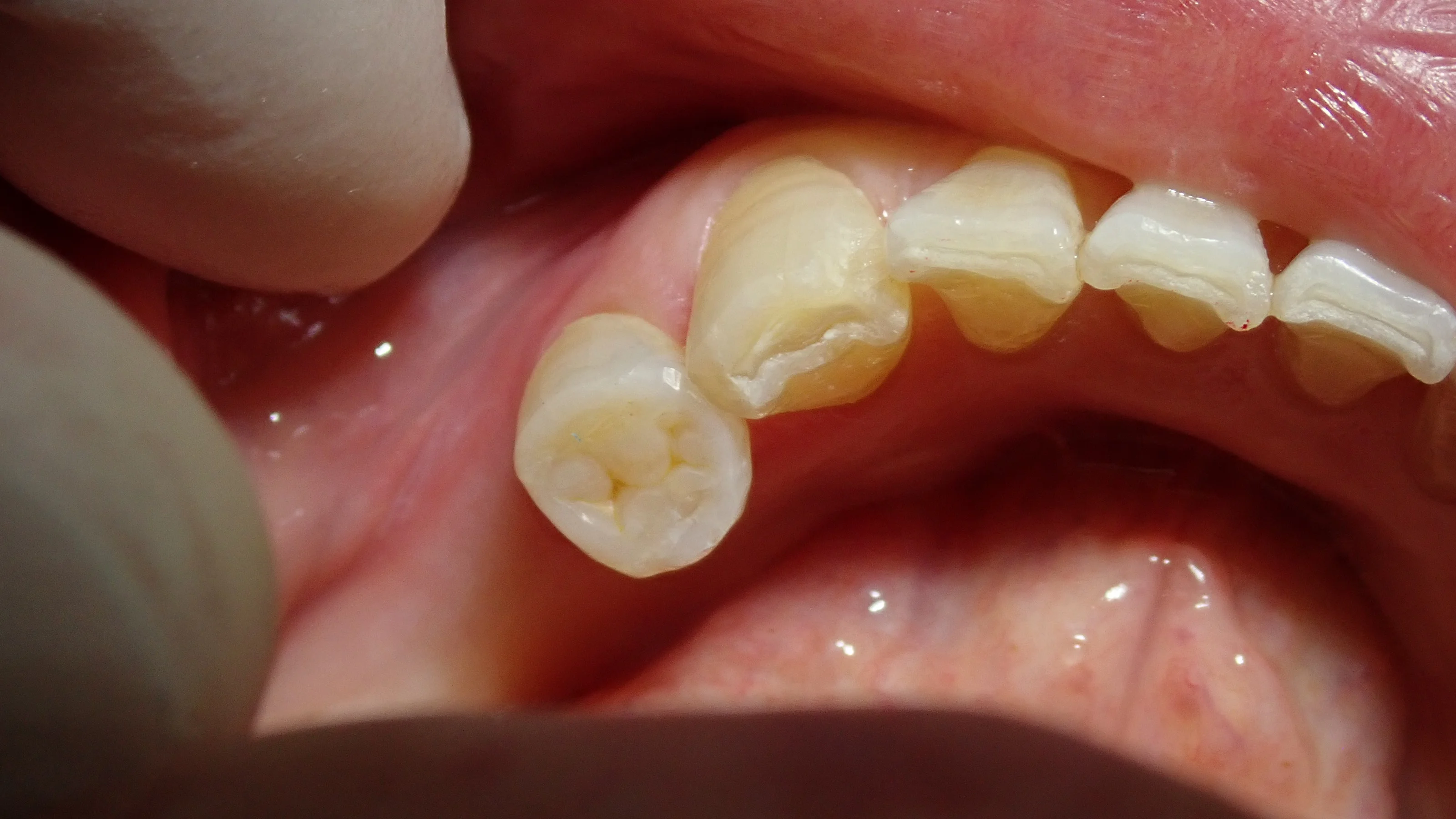 左下奥歯白い詰め物｜坂寄歯科医院（取手市藤代） - 画像2