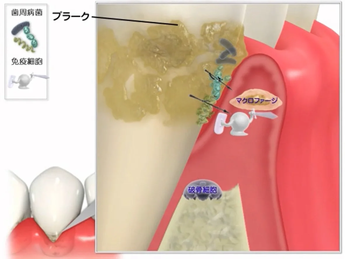 破骨細胞が歯槽骨を破壊している断面図