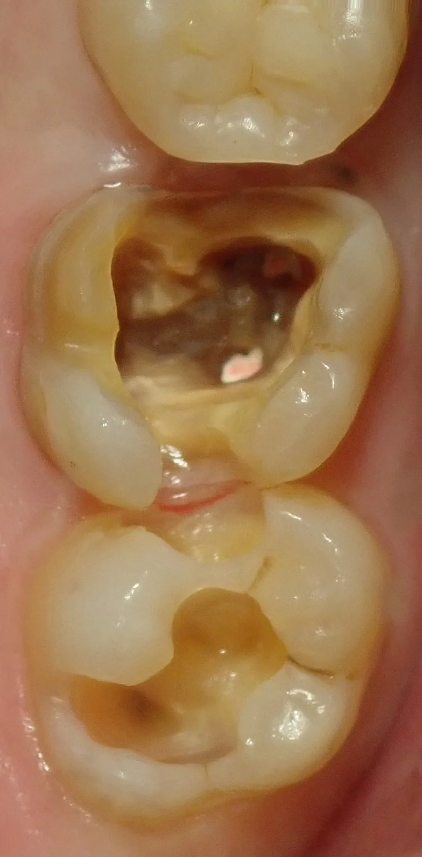 左上奥歯の白い詰め物|坂寄歯科医院(取手市藤代) - 画像3