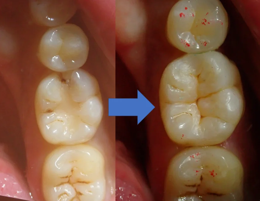 ダイレクトボンディング⑧｜坂寄歯科医院（取手市藤代） - 画像6
