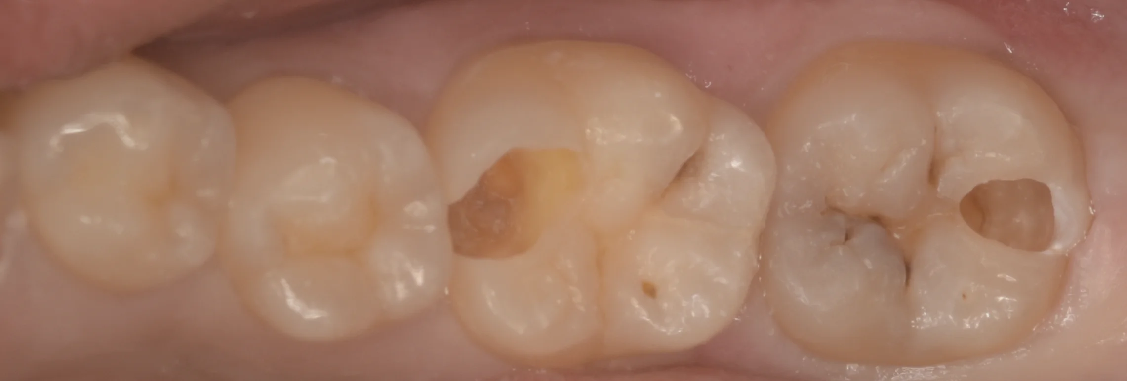 浦安から来た方をダイレクトボンディングで。｜坂寄歯科医院（取手市藤代） - 画像3