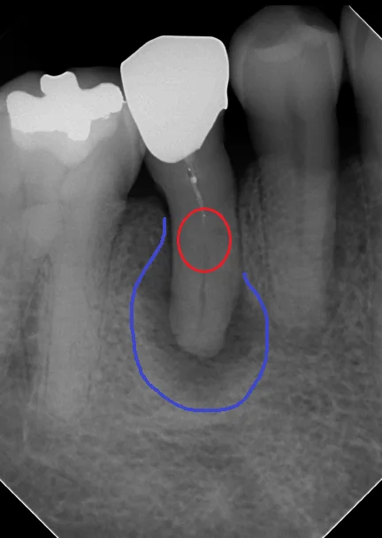 閉鎖根管の治療には根気が必要｜坂寄歯科医院（取手市藤代） - 画像2