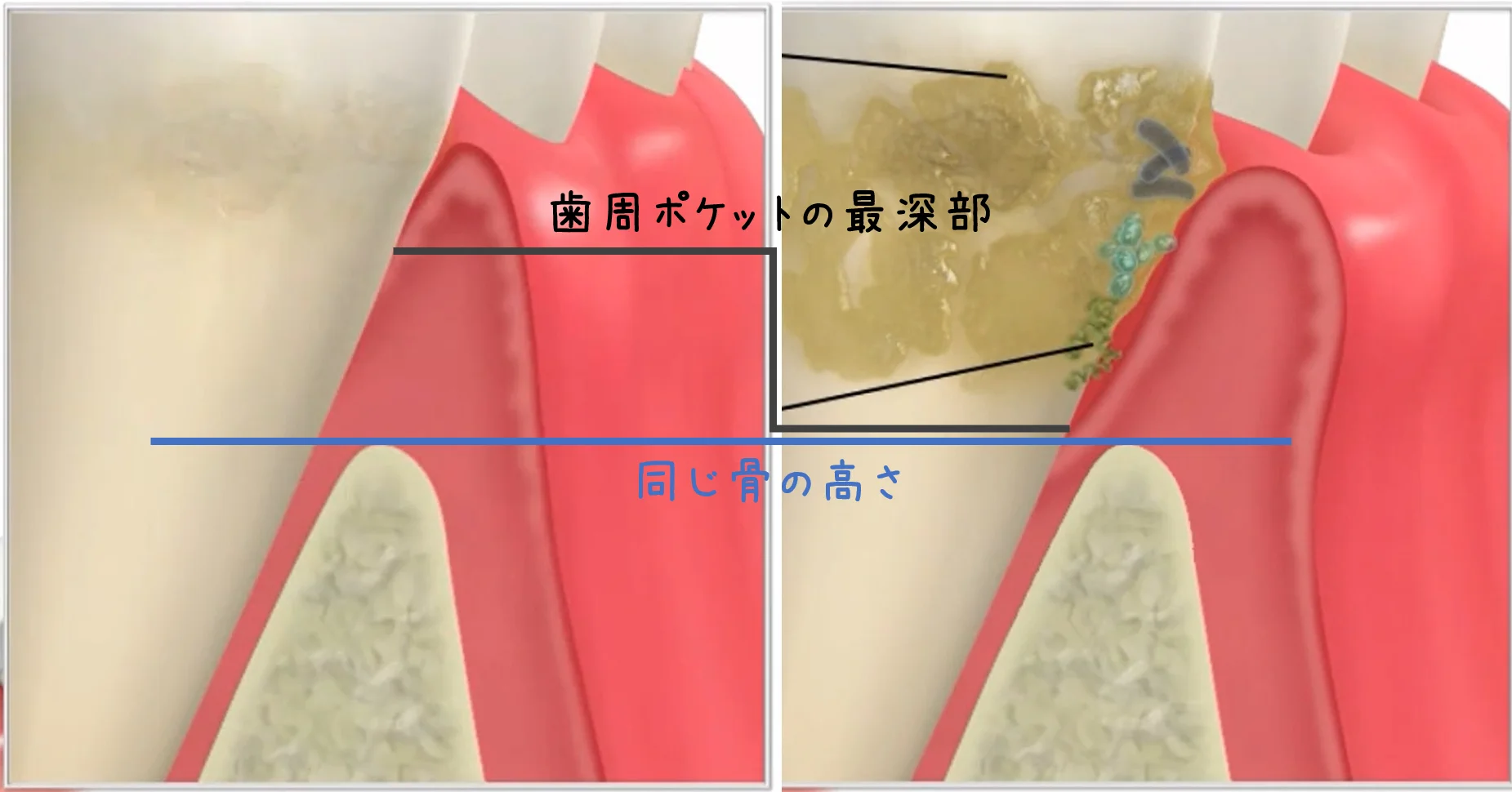 歯周ポケットの最深部が歯槽骨に近づいてきた比較断面図