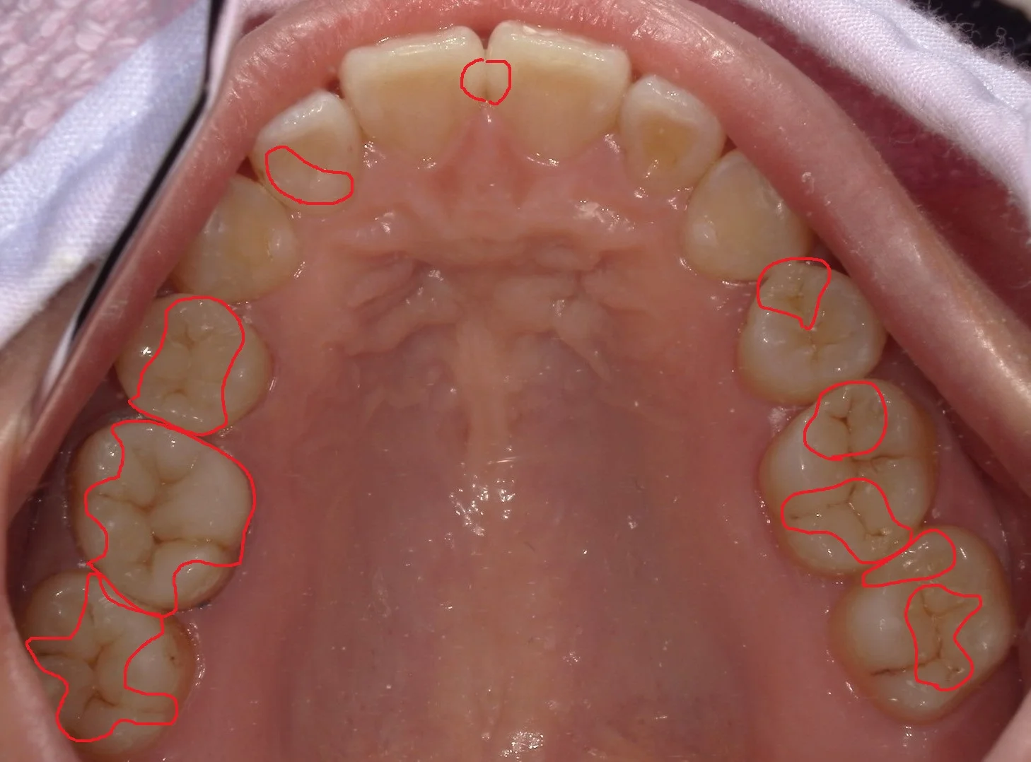 全顎的に白い詰め物で治した症例｜坂寄歯科医院（取手市藤代） - 画像3