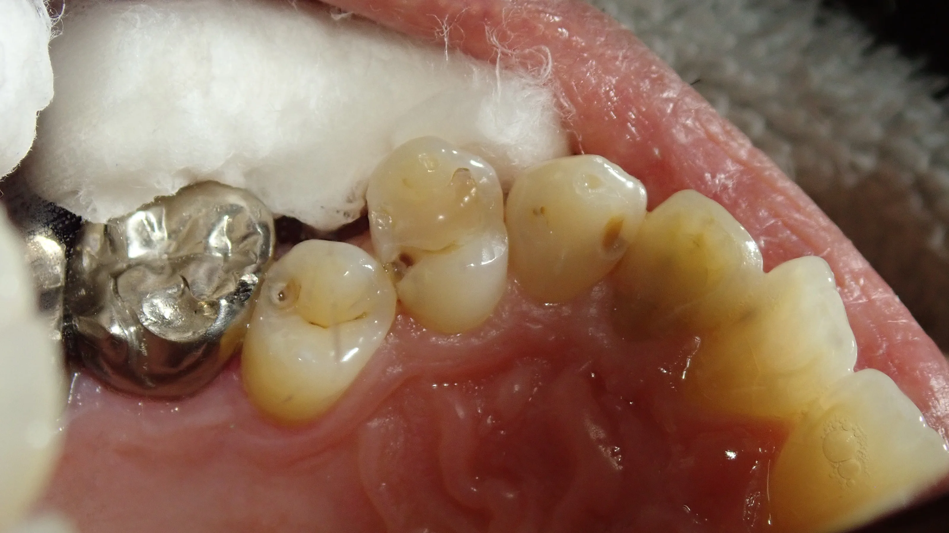 左上3本まとめてダイレクトボンディング|坂寄歯科医院(取手市藤代) - 画像2