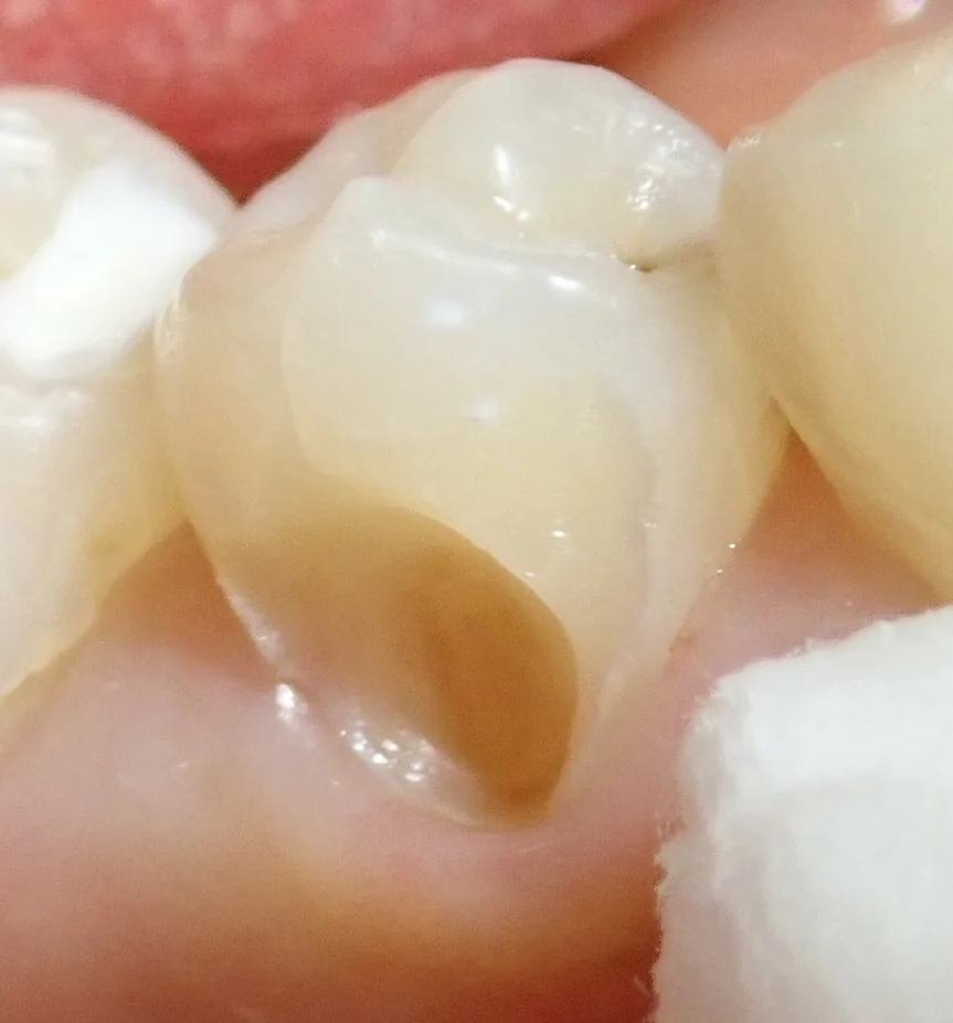 圧排糸を使ったレジン治療。｜坂寄歯科医院（取手市藤代） - 画像3