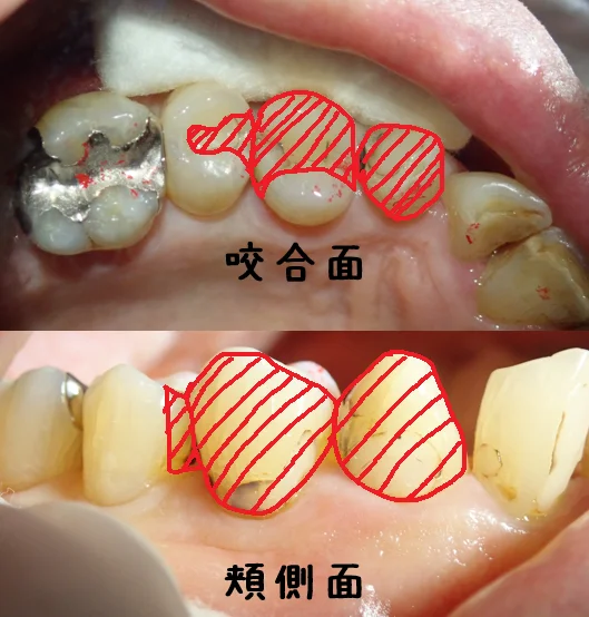 3本連続ダイレクトボンディング｜坂寄歯科医院（取手市藤代） - 画像2