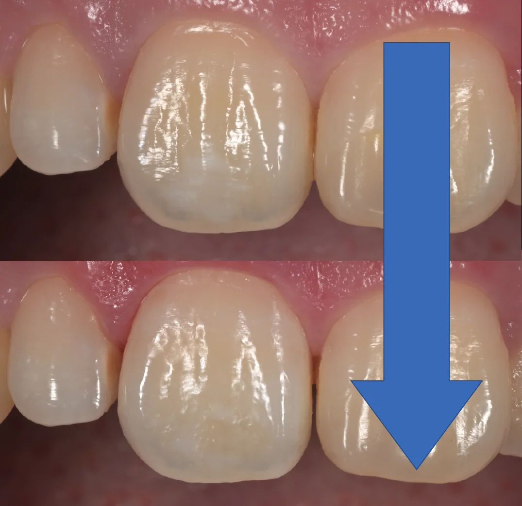 ICON治療にてホワイトスポットを改善。｜坂寄歯科医院（取手市藤代） - 画像6