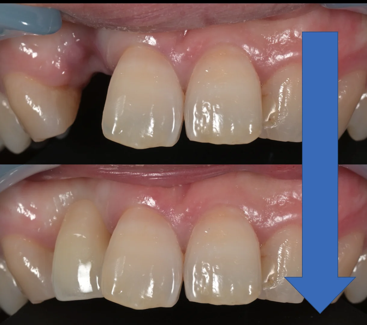 審美治療+歯質保存：延長セラミックブリッジ｜坂寄歯科医院（取手市藤代） - 画像6