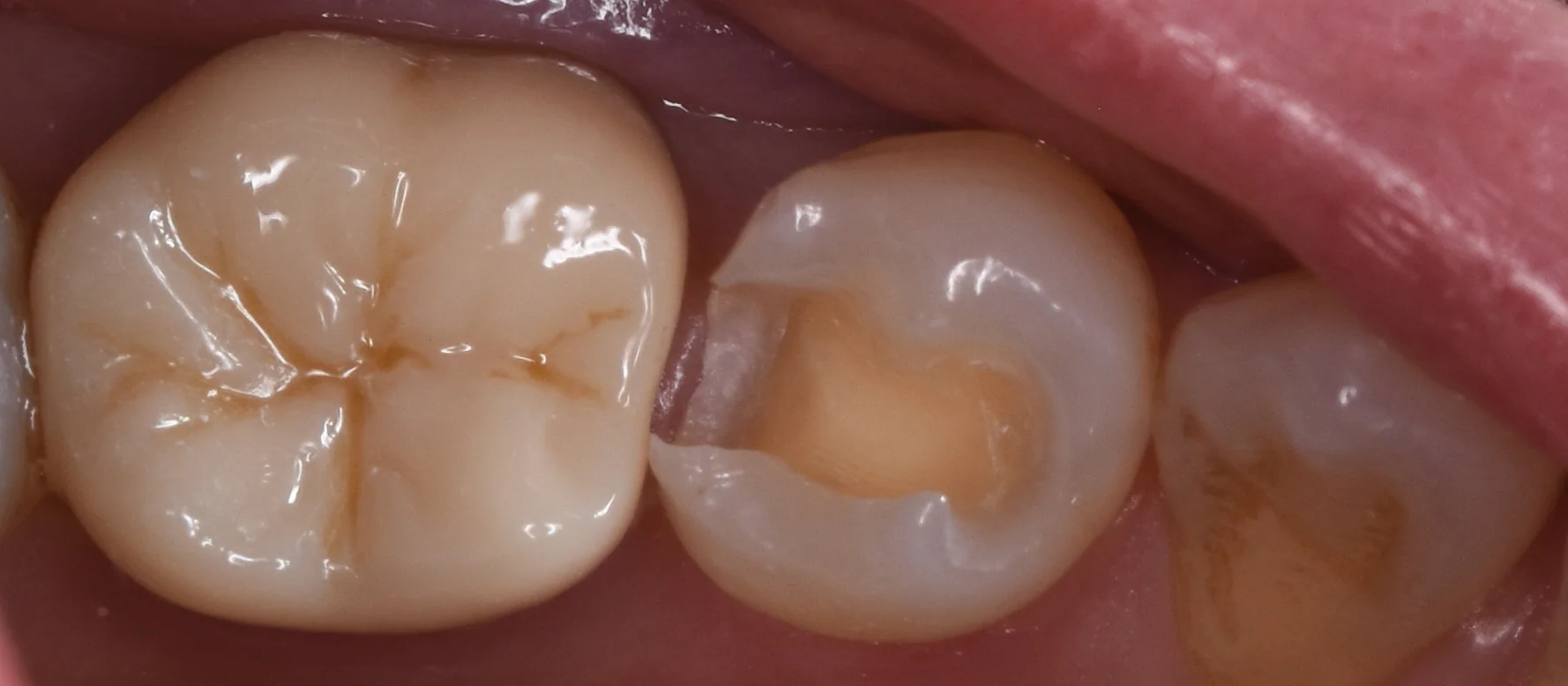 セラミックの被せ物｜坂寄歯科医院（取手市藤代） - 画像6