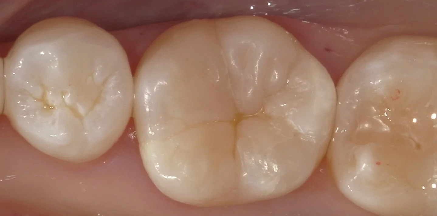 他院勤務中の歯科衛生士さんの治療を行いました。｜坂寄歯科医院（取手市藤代） - 画像3