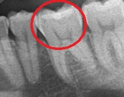 ダイレクトボンディング⑧｜坂寄歯科医院（取手市藤代） - 画像2