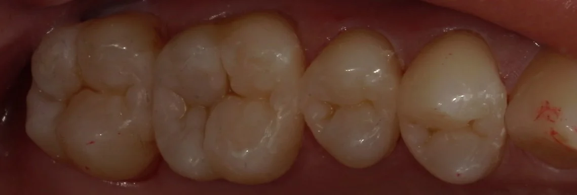 全体的に金属を白い詰め物に。｜坂寄歯科医院（取手市藤代） - 画像4