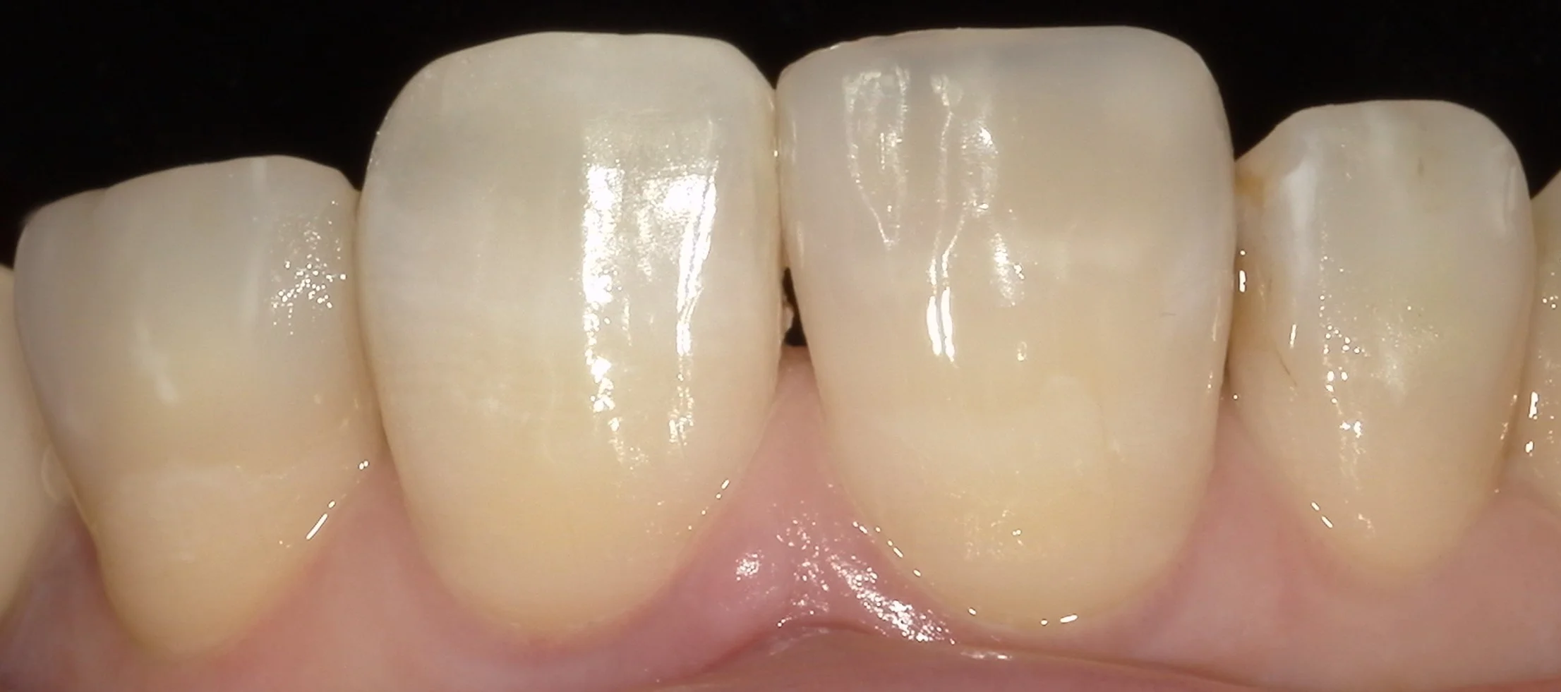 前歯が折れてしまったケース。|坂寄歯科医院(取手市藤代) - 画像4