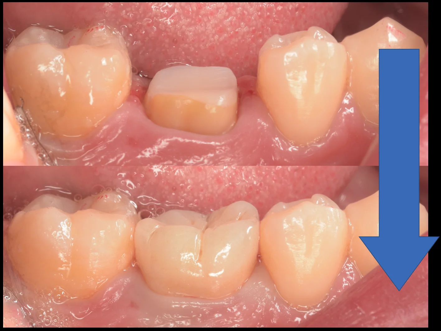 セラミックの被せ物｜坂寄歯科医院（取手市藤代） - 画像7