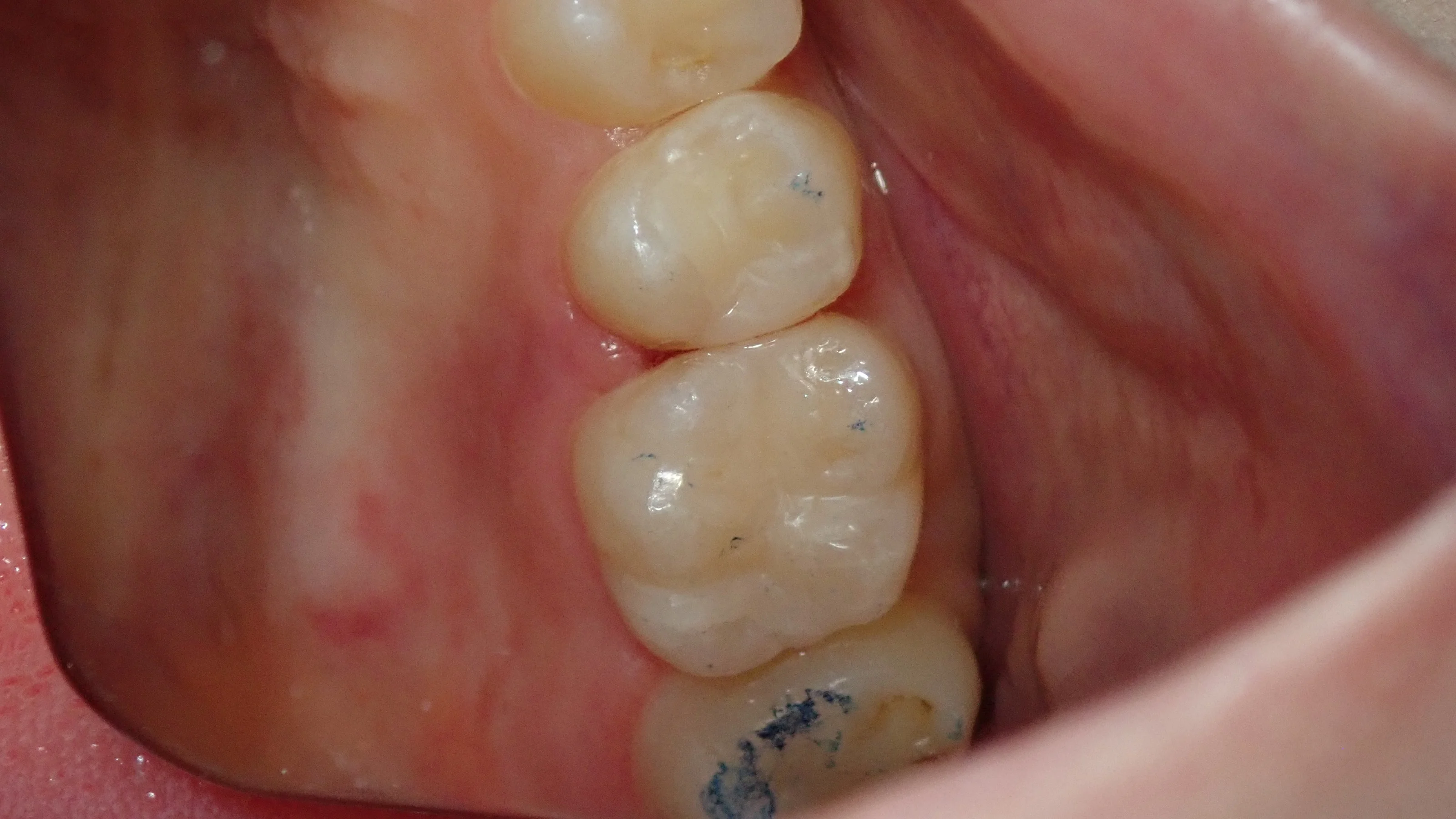 コンポジットレジン②|坂寄歯科医院(取手市藤代) - 画像4