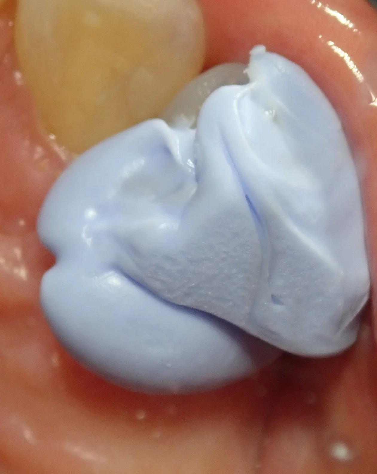 右上犬歯の白い詰め物｜坂寄歯科医院（取手市藤代） - 画像3