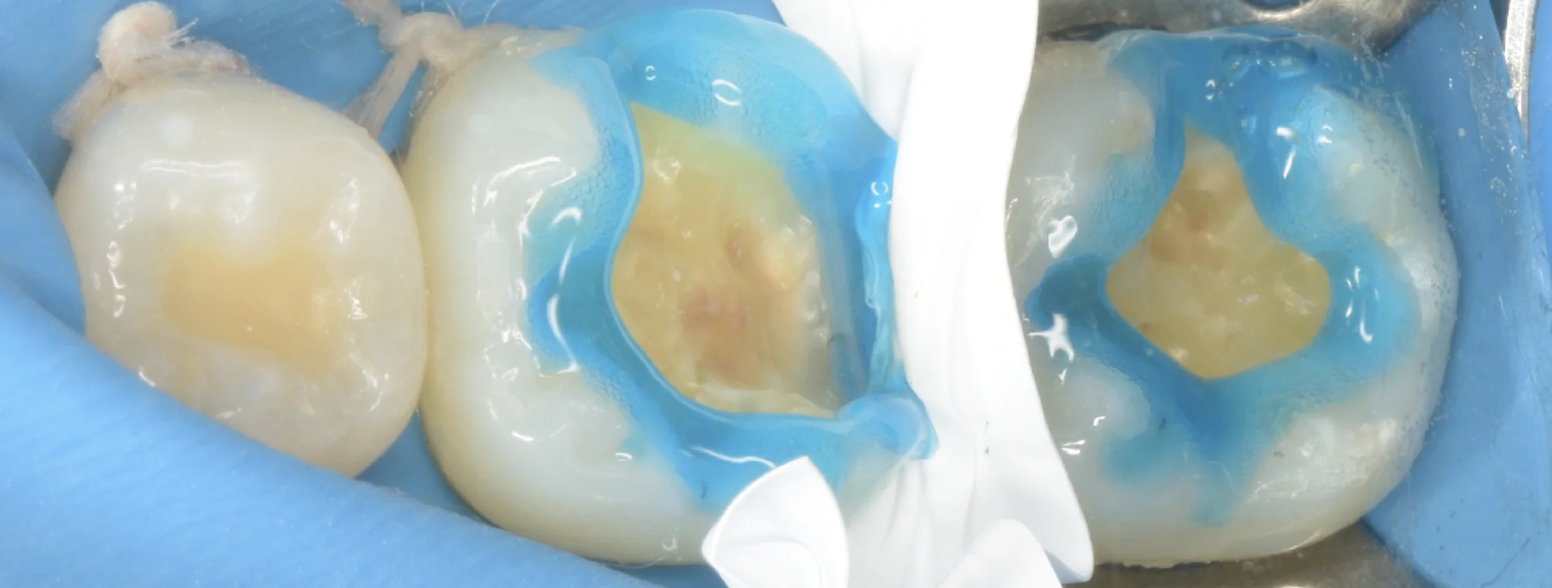 歯科医師の方のCAD/CAMインレーを治療。｜坂寄歯科医院（取手市藤代） - 画像4