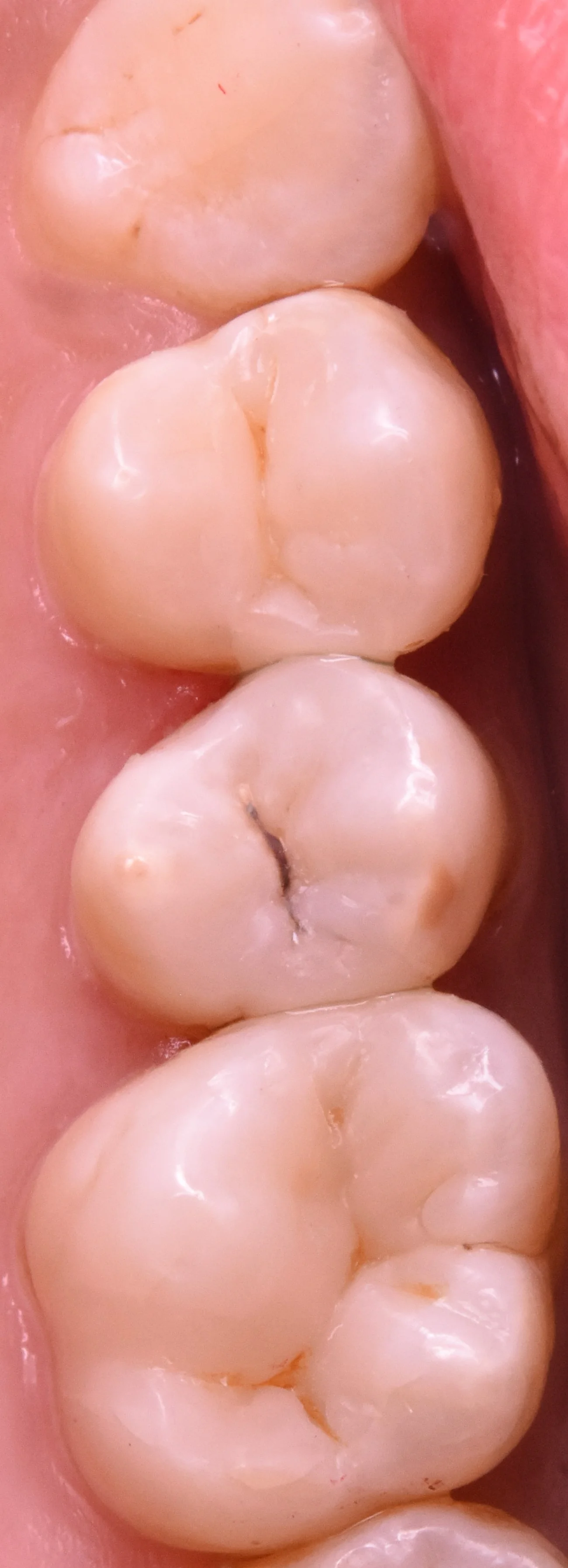 奥歯3本を纏めて一気に治療。｜坂寄歯科医院（取手市藤代） - 画像4