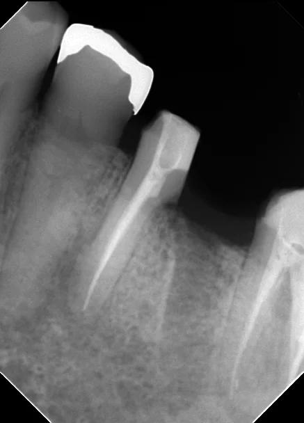 その抜歯ちょっと待って!|坂寄歯科医院(取手市藤代) - 画像3