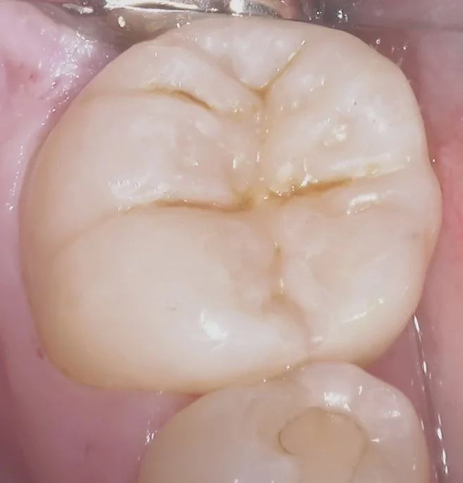 左下奥歯の白い詰め物｜坂寄歯科医院（取手市藤代） - 画像4