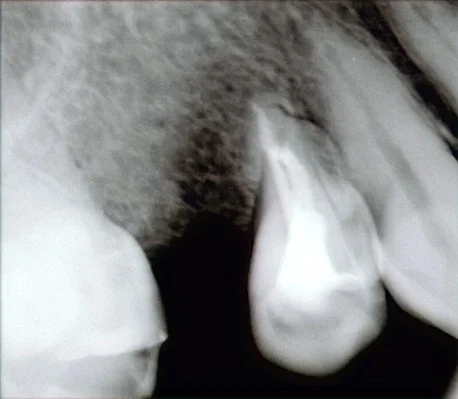 ダイレクトボンディング術後4年での補修修復｜坂寄歯科医院（取手市藤代） - 画像3